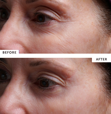 SilcSKin Eye Pad before & after