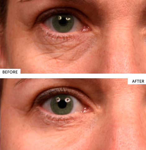 Eye Pad, Serum, HBT before and after
